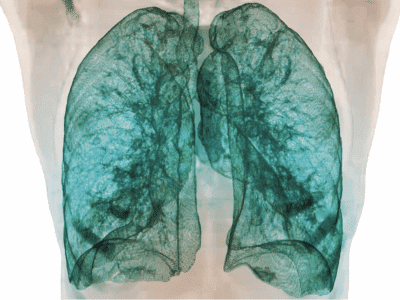 Tomografia do Tórax